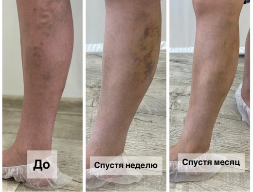 Файбер Клиник лечение варикоза лазером